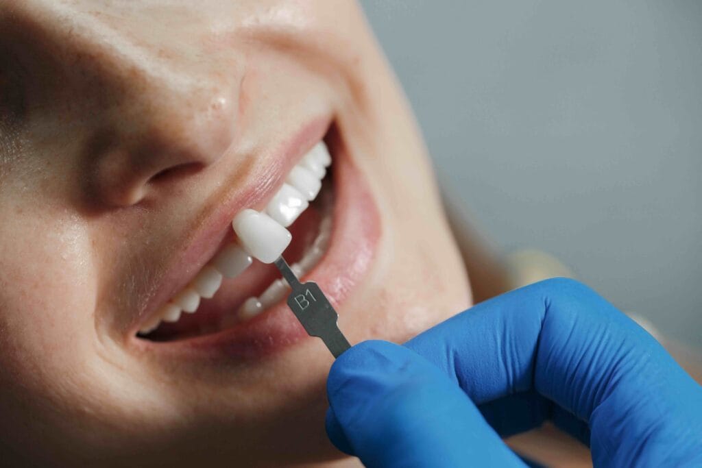 Come cambiano i denti con le faccette dentali