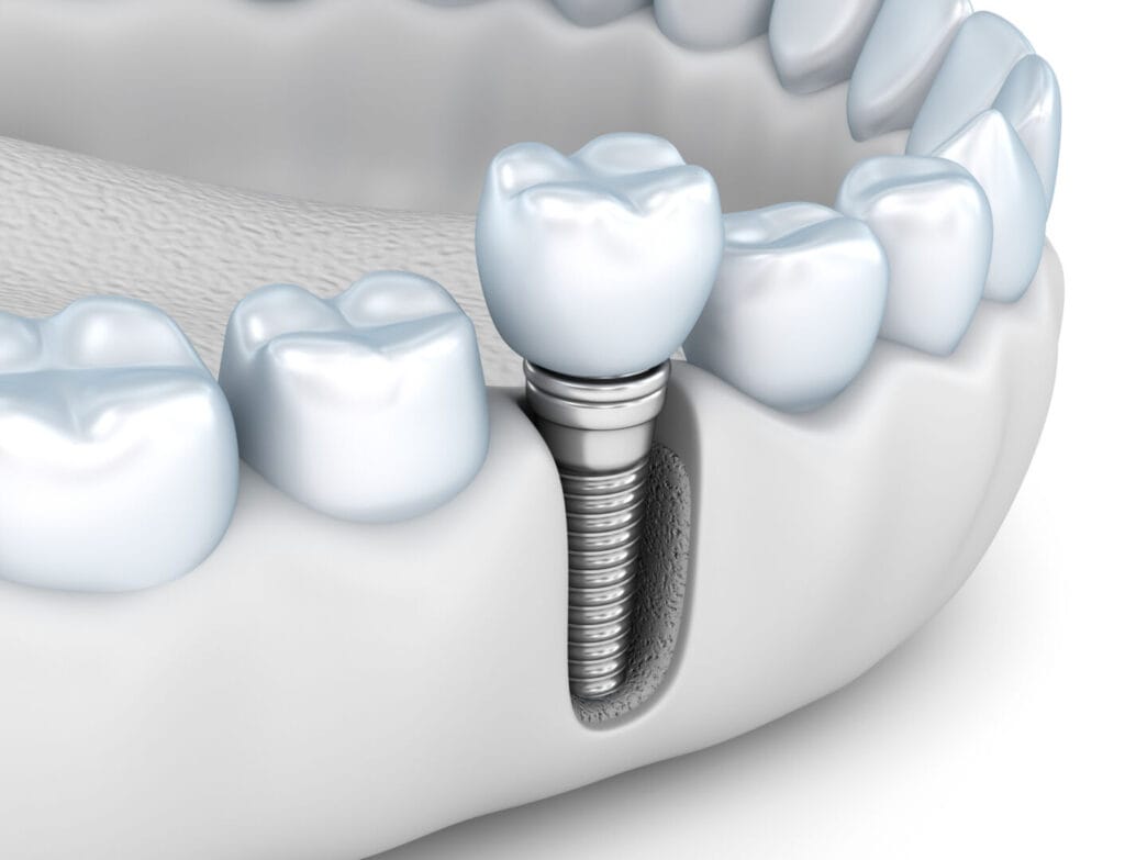 Come capire se un impianto dentale sta rigettando e come prevenirlo 1 Rigetto impianto dentale