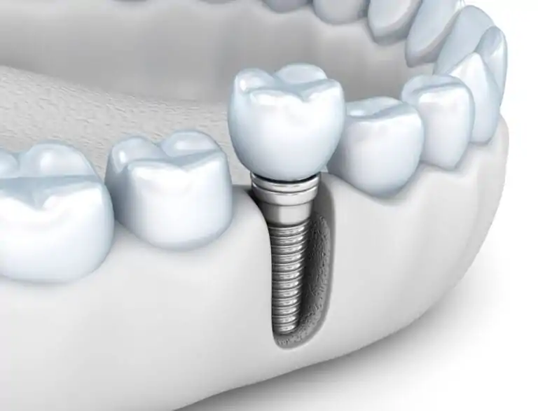 Rigetto impianto dentale Rigetto impianto dentale