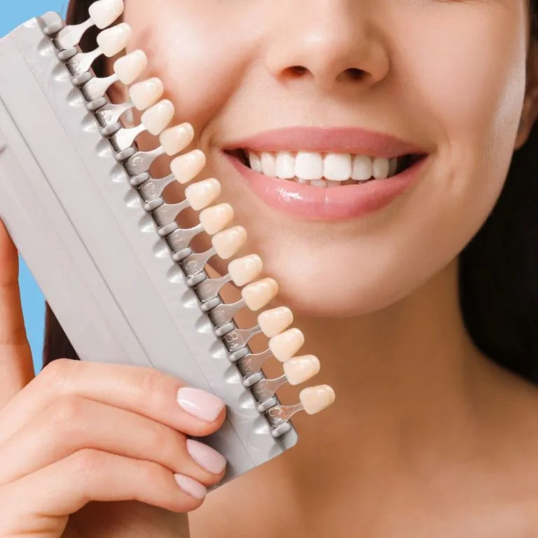 che cosa sono le faccette dentali che cosa sono le faccette dentali