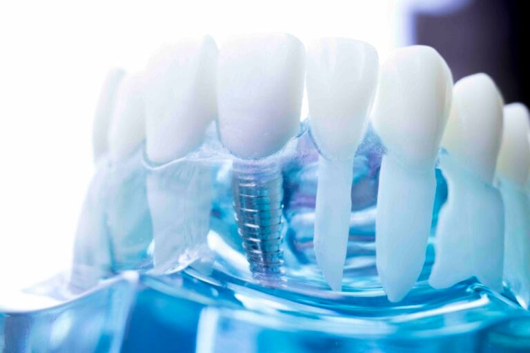 glossario implantologia dentale