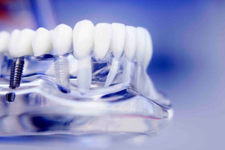 Quanto dura un impianto dentale Quanto dura un impianto dentale
